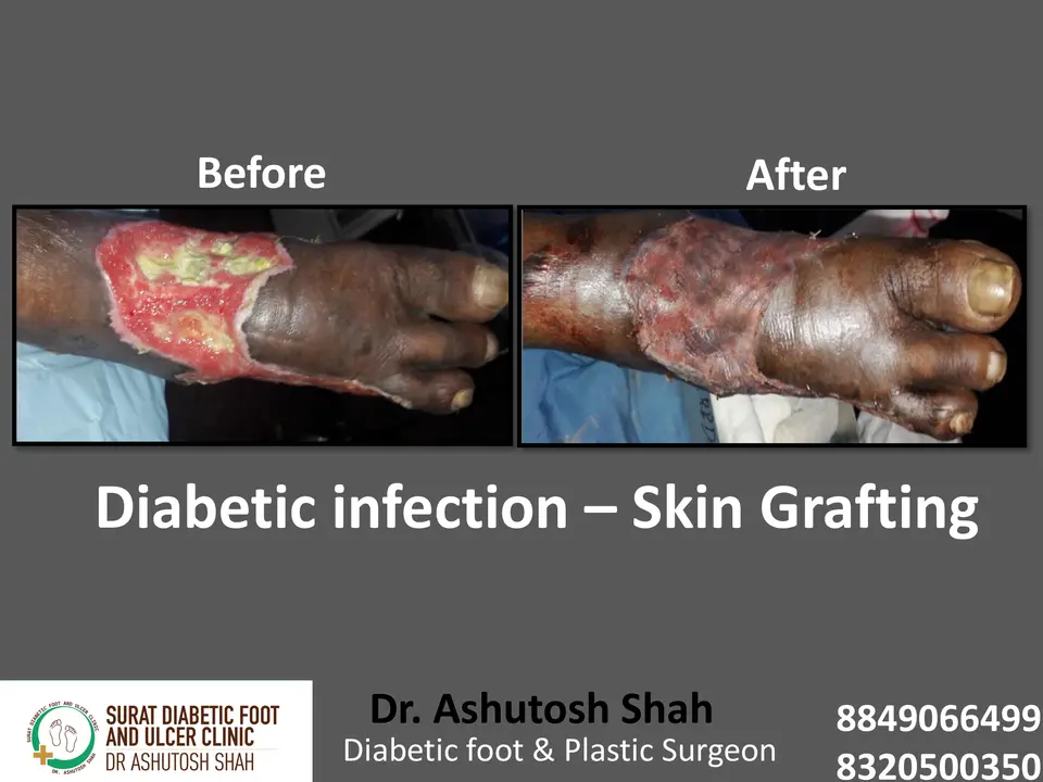 Diabetic Foot  PPT 3 checked by sir.pptx-91.webp